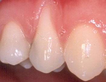 Υποχώρηση ούλου από τραυματικό βούρτσισμα